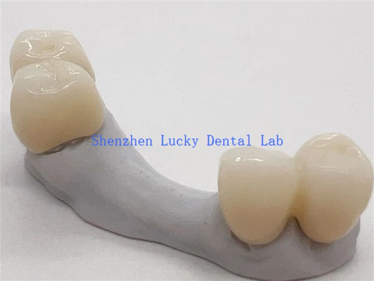 3D Print Aesthetic Dental Zirconia Bridge
