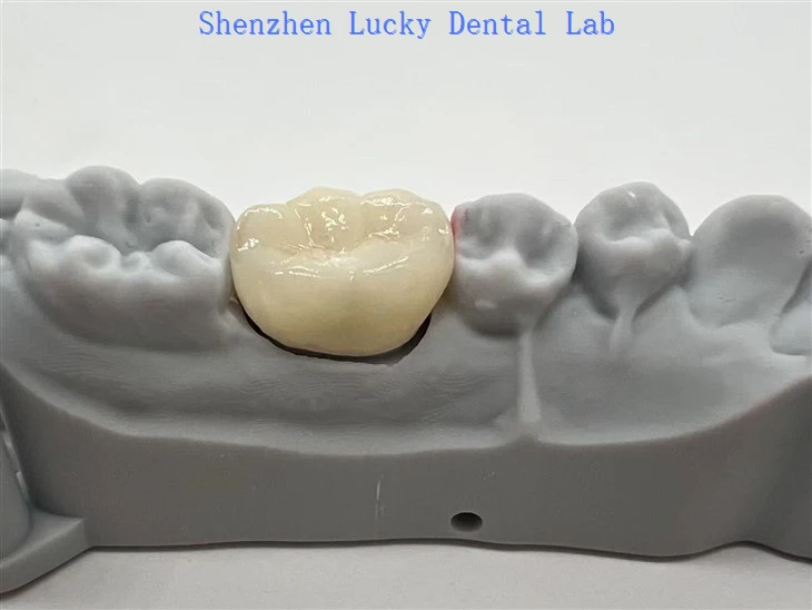 3D Print Dental Full Contour Zirconia Crown Dental Laboratory