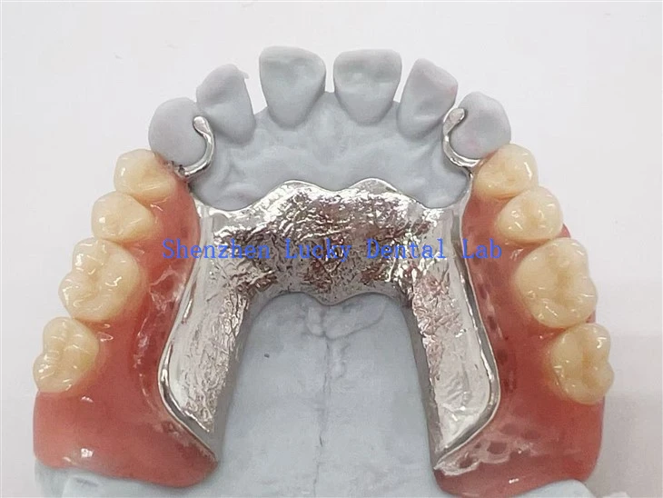 3D Print CoCr Cast Framework With Acrylic Denture