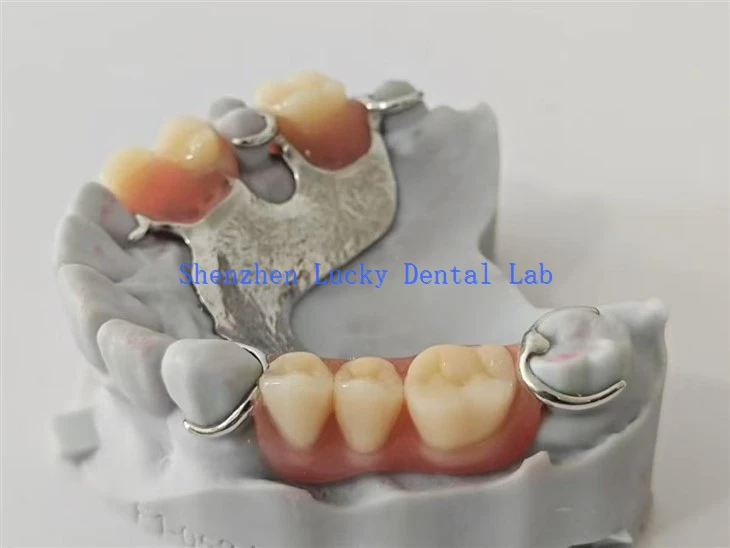 3D Print Dental Metal Framework Dental Lab