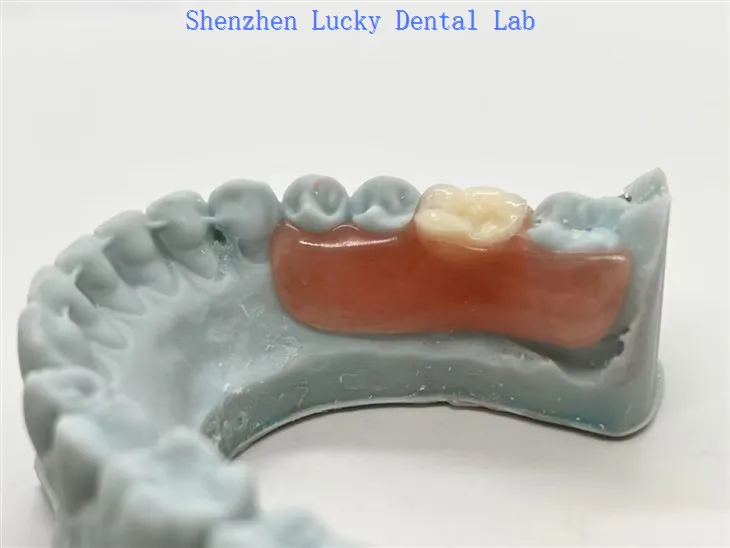 3D Print Nesbit Partial Acrylic Denture