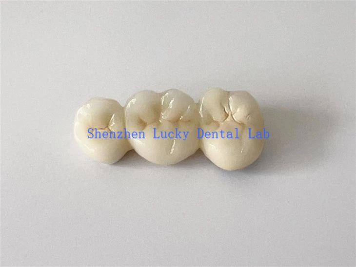 China Customized PFM CoCr Bridge Dental Lab