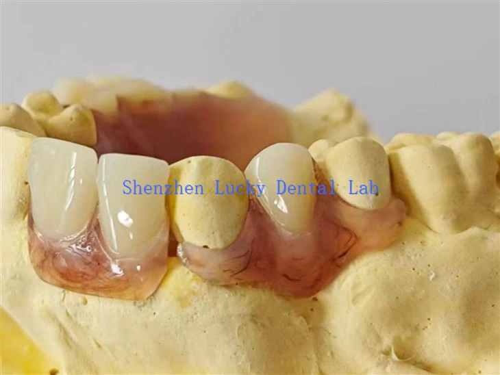 Dark Gum Dental Partial Flexible Denture Dental Laboratory