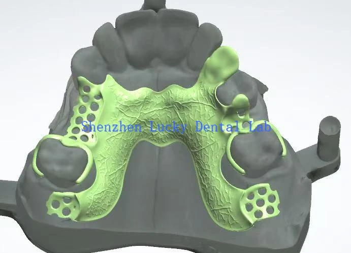 3D Print Dental Metal Framework Design