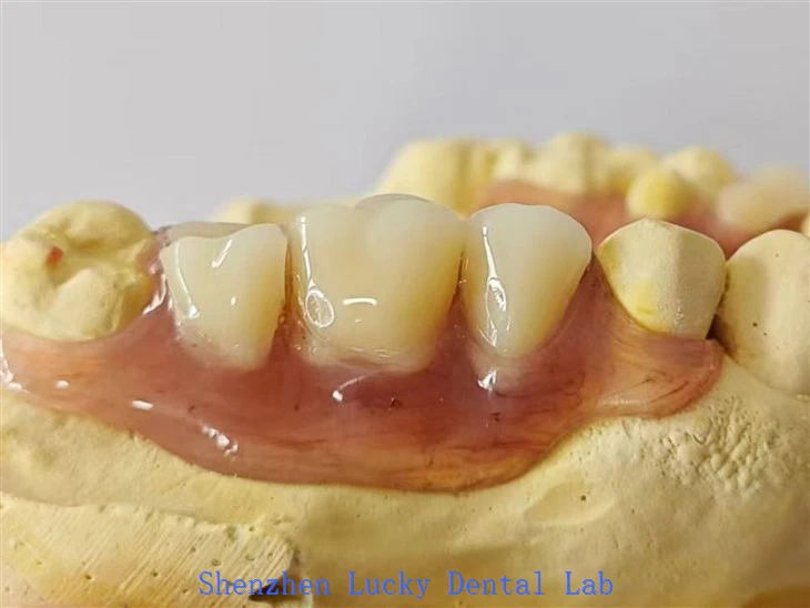 Dental Partial Flexible Denture with Dark Gum