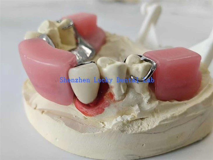 Dental Precision Attachment Of The Bolt-Channel With Metal Framework And Bite Block