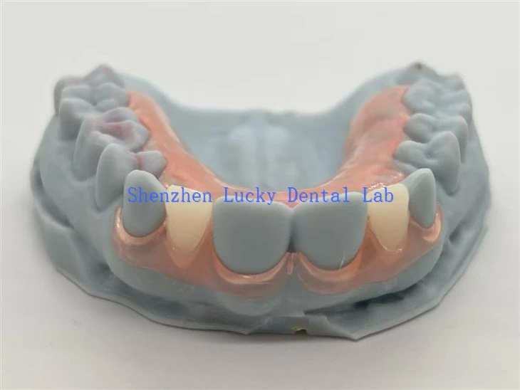 Dental TCS Flexible Partial Dentures