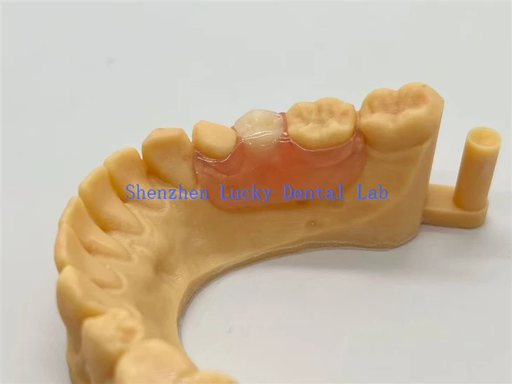 Flexible Nesbit Flipper Denture