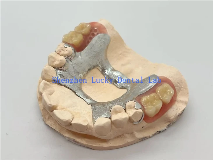 Horseshoe-Shaped Partial Metal Frame Denture