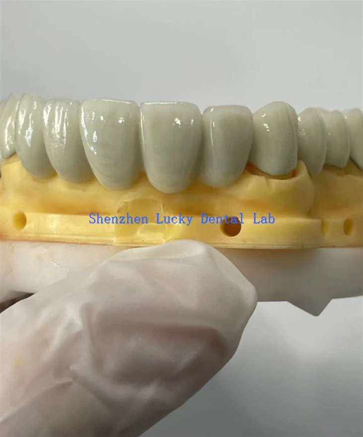Customized PFM CoCr Dental Bridge Dental Lab
