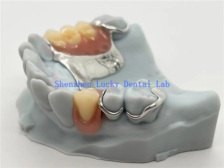 Metal Co Cr Frame With Acrylic Dentures