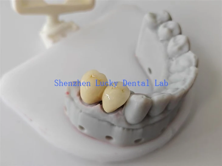 Natural 3D Print Dental PFM CoCr Crown Dental Lab