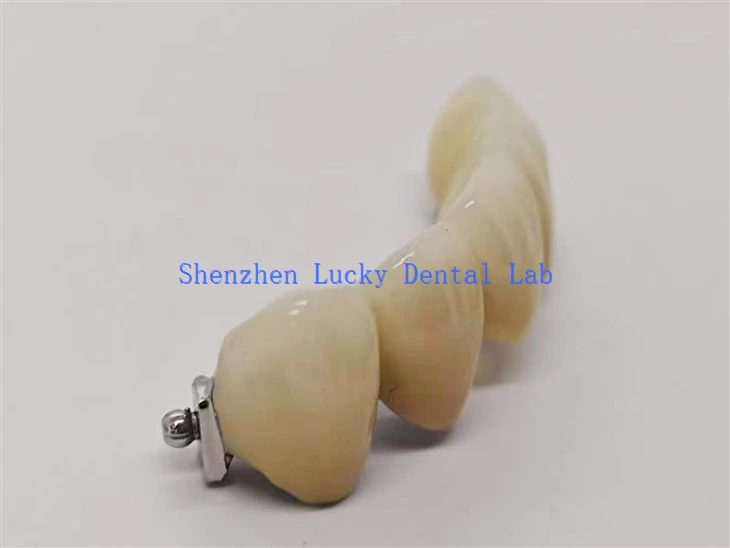 PFM CoCr Bridge With Precision Ball Attachment Dental Lab