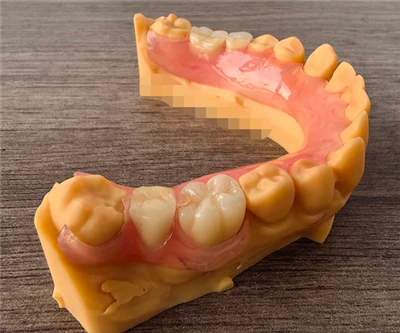 Removable Flexible Denture With Fixed Zircornia Crown