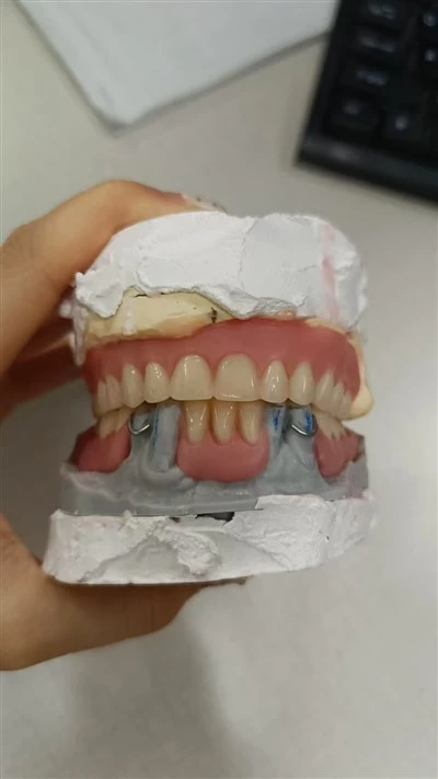Full Acrylic Denture Try in Affordable