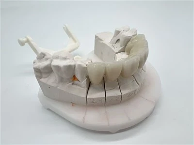 Zirconia Bridge Authentic Comfortable